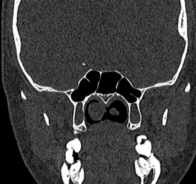 Antrochoanal polyp (Radiopaedia 30002-30554 Coronal bone window 62).jpg
