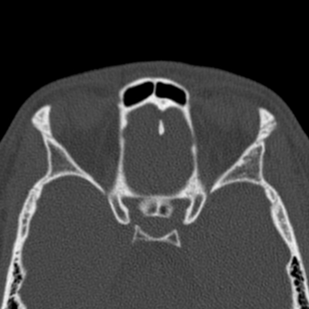 Antrochoanal polyp (Radiopaedia 33984-35202 Axial bone window 62).jpg