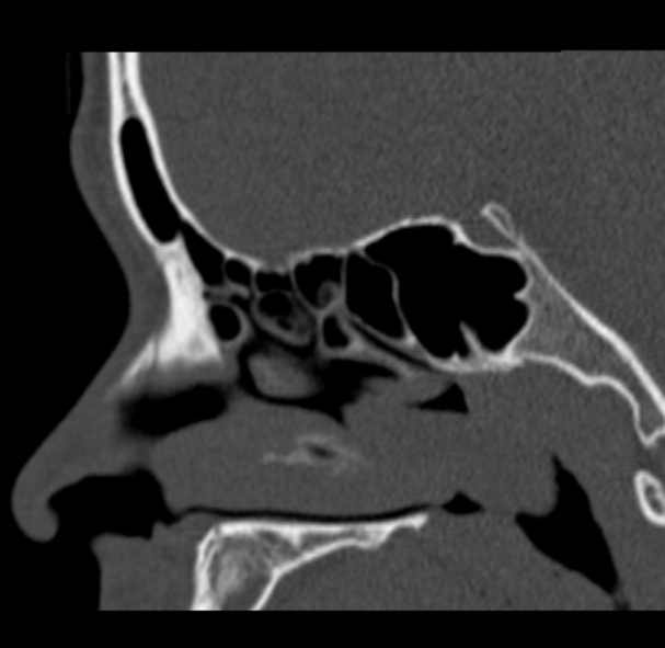 Antrochoanal polyp (Radiopaedia 33984-35202 Sagittal bone window 35).jpg