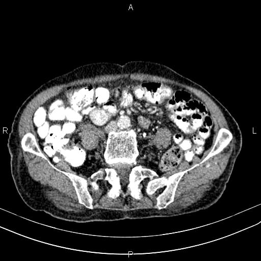 File:Aortic aneurysm and Lemmel syndrome (Radiopaedia 86499-102554 A 53).jpg