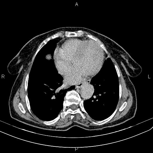 File:Aortic aneurysm and Lemmel syndrome (Radiopaedia 86499-102554 Axial C+ delayed 2).jpg