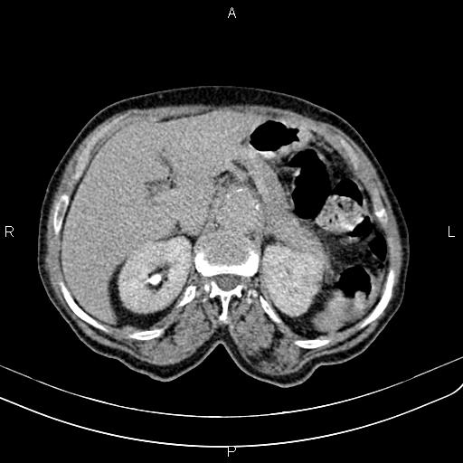 Aortic aneurysm and Lemmel syndrome (Radiopaedia 86499-102554 Axial C+ delayed 24).jpg