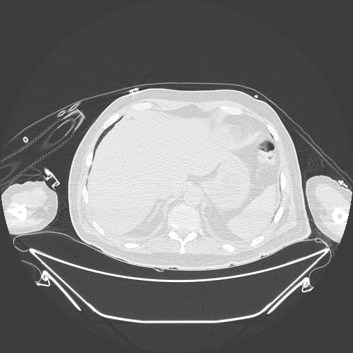 Aortic arch aneurysm (Radiopaedia 84109-99365 Axial lung window 246).jpg
