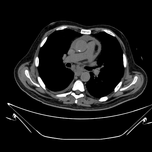 Aortic arch aneurysm (Radiopaedia 84109-99365 Axial non-contrast 132).jpg
