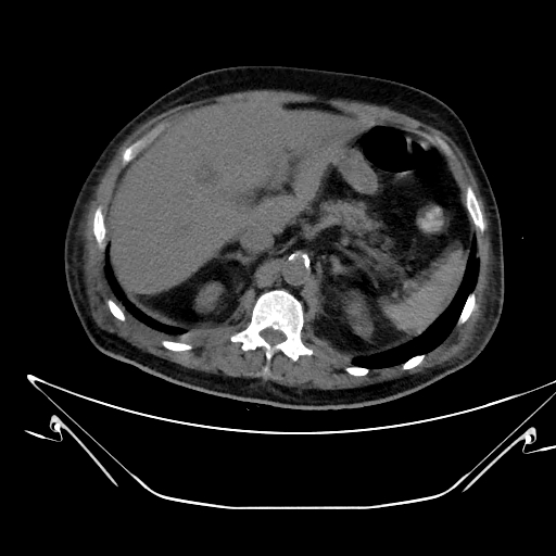 Aortic arch aneurysm (Radiopaedia 84109-99365 Axial non-contrast 282).jpg