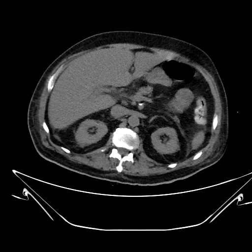 Aortic arch aneurysm (Radiopaedia 84109-99365 Axial non-contrast 303).jpg