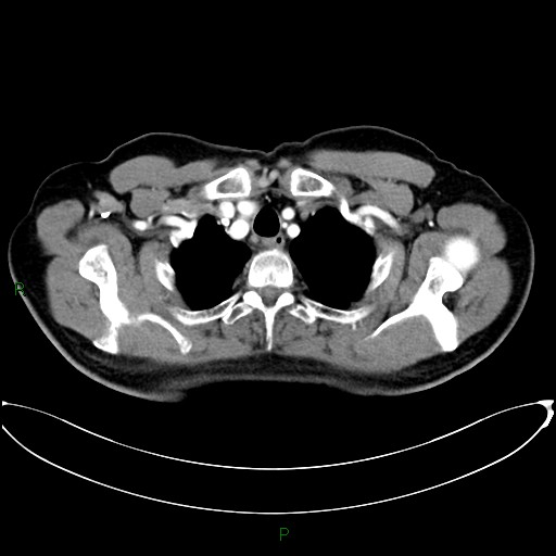 File:Aortic arch origin of left vertebral artery (Radiopaedia 46327-50737 Axial post contrast 17).jpg