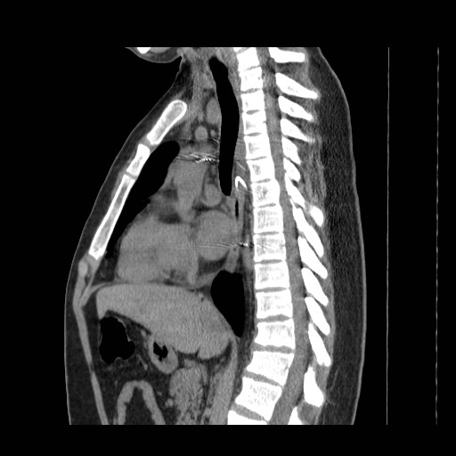 File:Aortic arch stent (Radiopaedia 30030-30595 B 8).jpg