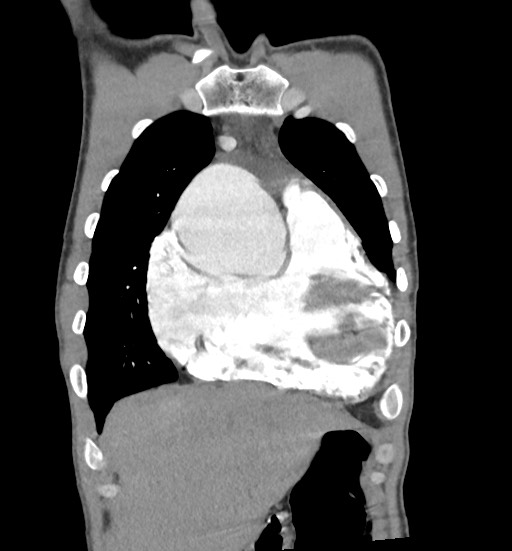 Aortic coarctation with aneurysm (Radiopaedia 74818-85828 C 26).jpg