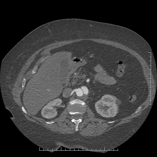 Aortic dissection- Stanford A (Radiopaedia 35729-37268 B 57).jpg