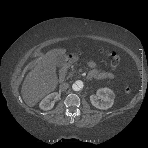 Aortic dissection- Stanford A (Radiopaedia 35729-37268 B 61).jpg