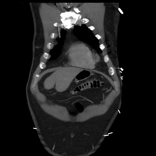 File:Aortic dissection- Stanford A (Radiopaedia 37759-39664 Coronal C+ delayed 2).png