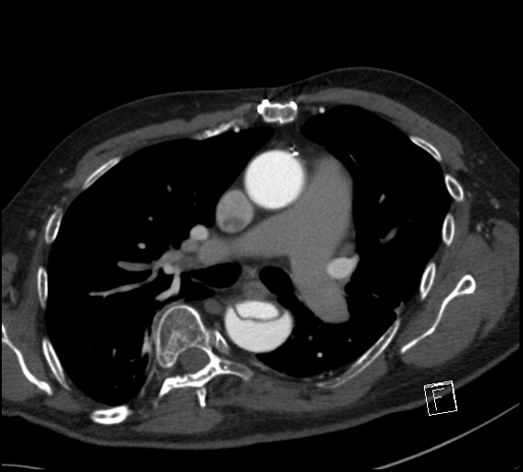 File:Aortic dissection (CTPA) (Radiopaedia 75506-86750 A 42).jpg