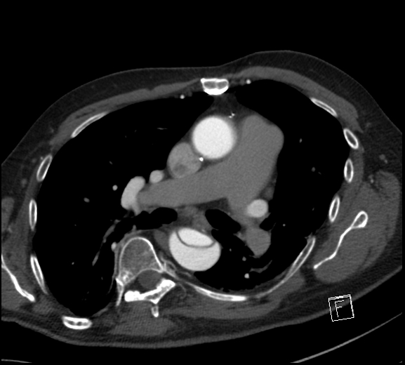 File:Aortic dissection (CTPA) (Radiopaedia 75506-86750 A 44).jpg
