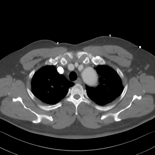 Aortic dissection (Radiopaedia 50763-56234 A 4).png