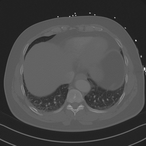 Aortic dissection (Radiopaedia 50763-56234 Axial bone window 80).png