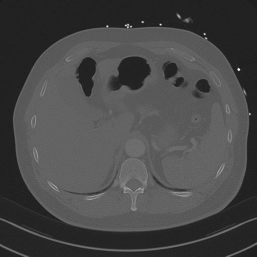 Aortic dissection (Radiopaedia 50763-56234 Axial bone window 97).png