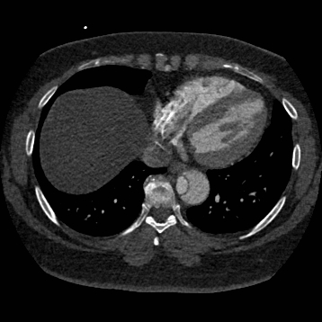 Aortic dissection (Radiopaedia 57969-64959 A 219).jpg