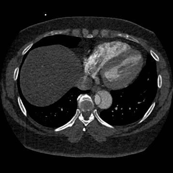 File:Aortic dissection (Radiopaedia 57969-64959 A 223).jpg