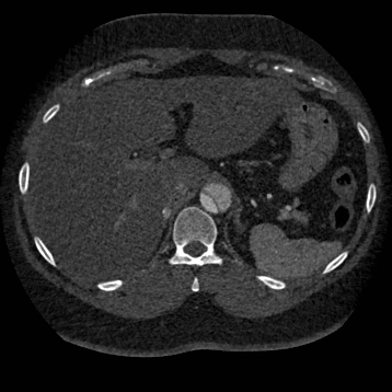 Aortic dissection (Radiopaedia 57969-64959 A 308).jpg