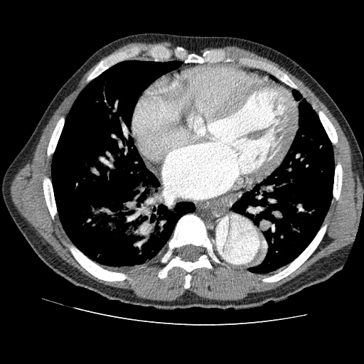 File:Aortic dissection - Stanford A -DeBakey I (Radiopaedia 28339-28587 B 61).jpg