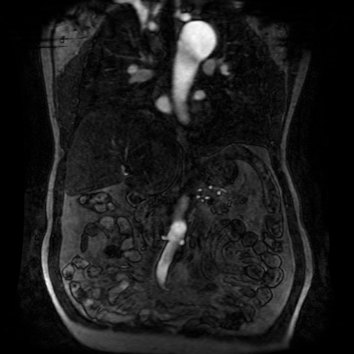 Aortic dissection - Stanford A - DeBakey I (Radiopaedia 23469-23551 D 115).jpg