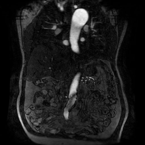 Aortic dissection - Stanford A - DeBakey I (Radiopaedia 23469-23551 D 119).jpg