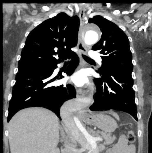 Aortic dissection - Stanford type B (Radiopaedia 50171-55512 B 47).png