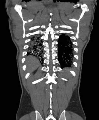 Aortic dissection - Stanford type B (Radiopaedia 73648-84437 B 102).jpg