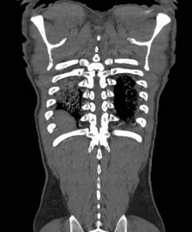 File:Aortic dissection - Stanford type B (Radiopaedia 73648-84437 B 105).jpg