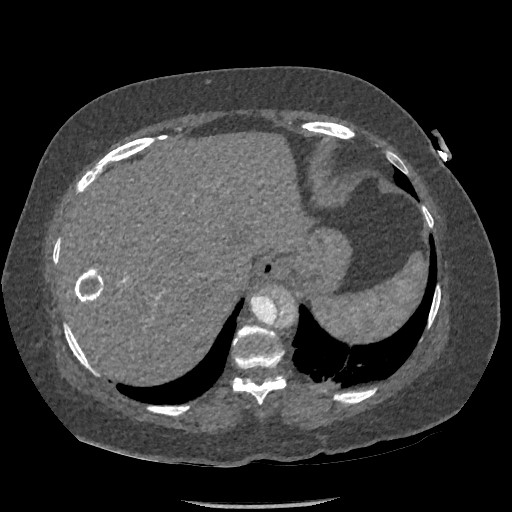 File:Aortic dissection - Stanford type B (Radiopaedia 88281-104910 A 82).jpg