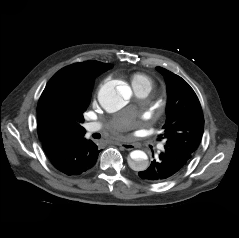 Aortic dissection with rupture into pericardium (Radiopaedia 12384-12647 A 28).jpg