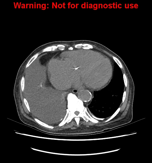 Aortic graft infection (Radiopaedia 44979-48907 Axial non-contrast 14).jpg
