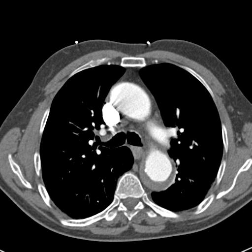 Aortic intramural hematoma (Radiopaedia 31139-31838 B 35).jpg