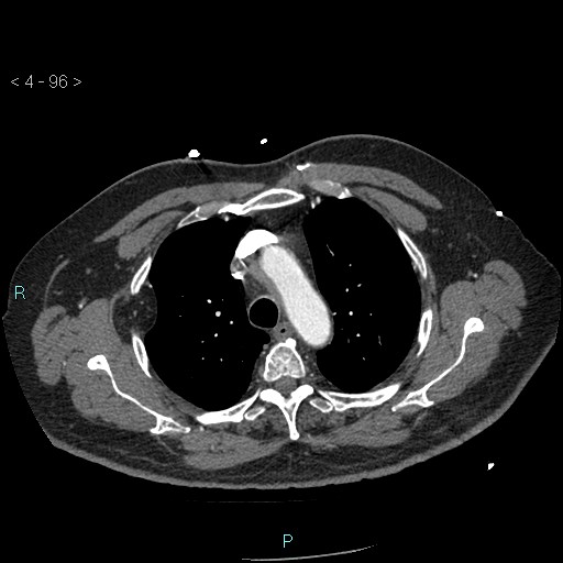 File:Aortic intramural hematoma (Radiopaedia 48463-53380 B 44).jpg