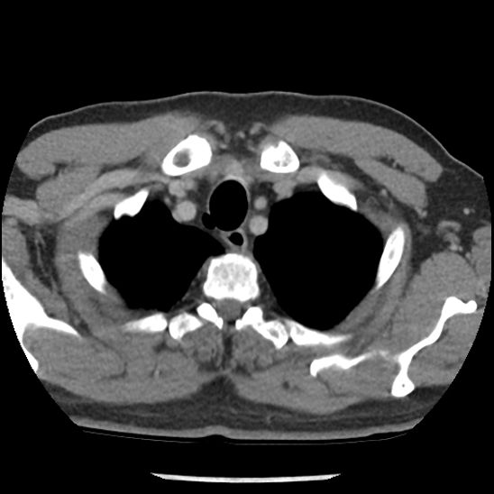 File:Aortic intramural hematoma (type B) (Radiopaedia 79323-92387 Axial C+ delayed 4).jpg