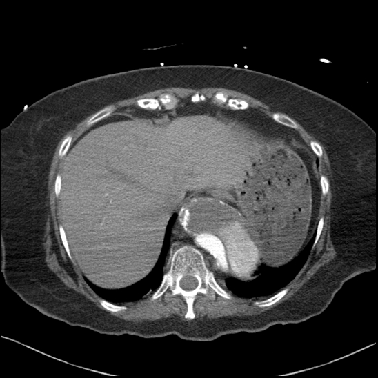Aortic intramural hematoma with dissection and intramural blood pool (Radiopaedia 77373-89491 B 93).jpg