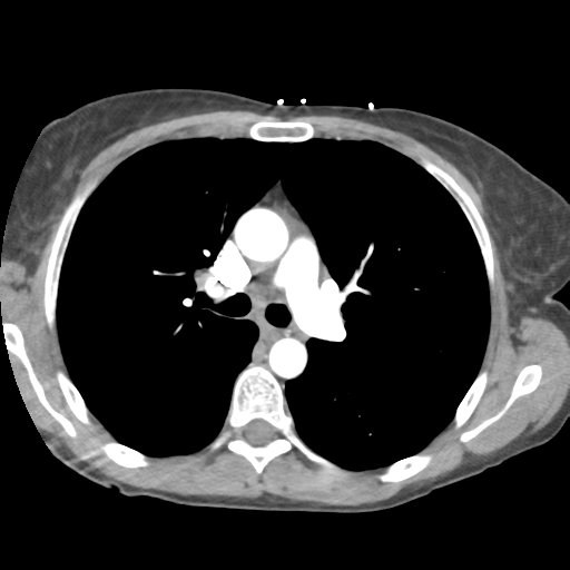 File:Aortic valve non-coronary cusp thrombus (Radiopaedia 55661-62189 B 20).png