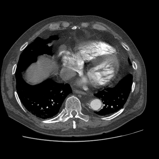 File:Aorto-coronary bypass graft aneurysms (Radiopaedia 40562-43157 A 90).png