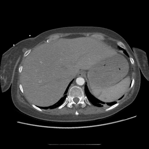 Aorto-duodenal fistula (Radiopaedia 25668-25850 A 8).jpg