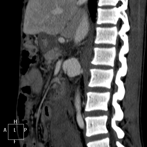 Aorto-left renal vein fistula (Radiopaedia 45534-49628 C 29).jpg
