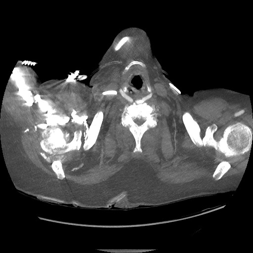 File:Aortoesophageal fistula with endovascular repair (Radiopaedia 73781-84592 Axial 264).jpg