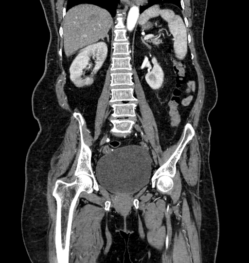 Aortoiliac occlusive disease (Radiopaedia 52352-58248 B 36).jpg