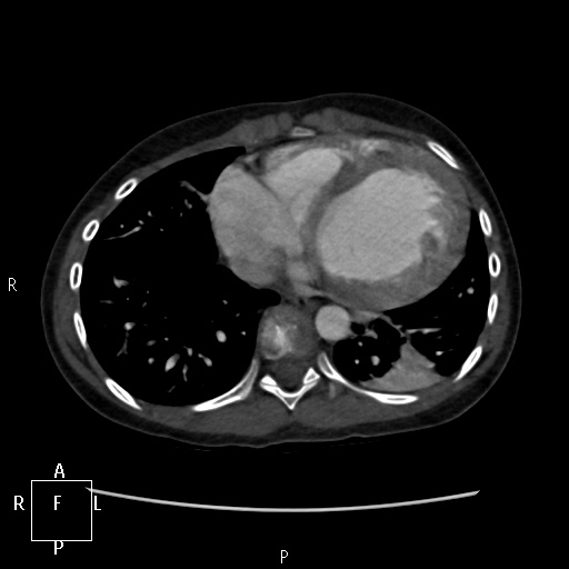 File:Aortopulmonary septal defect (Radiopaedia 41990-45013 Axial C+ CTPA 16).jpg