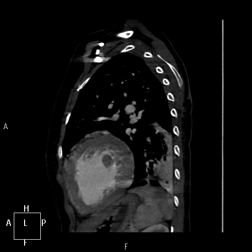 File:Aortopulmonary septal defect (Radiopaedia 41990-45013 Sagittal C+ CTPA 3).jpg