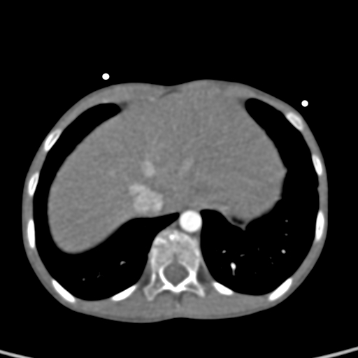 File:Aortopulmonary window, interrupted aortic arch and large PDA giving the descending aorta (Radiopaedia 35573-37074 B 81).jpg