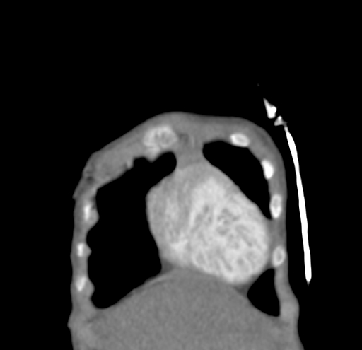 File:Aortopulmonary window, interrupted aortic arch and large PDA giving the descending aorta (Radiopaedia 35573-37074 D 2).jpg