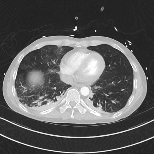 Apical bullous disease in a heavy smoker (Radiopaedia 33067-34092 Axial lung window 45).png
