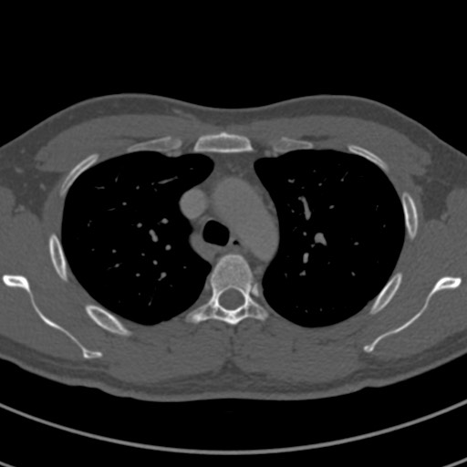 File:Apical lung mass mimic - neurogenic tumor (Radiopaedia 59918-67521 Axial bone window 25).jpg