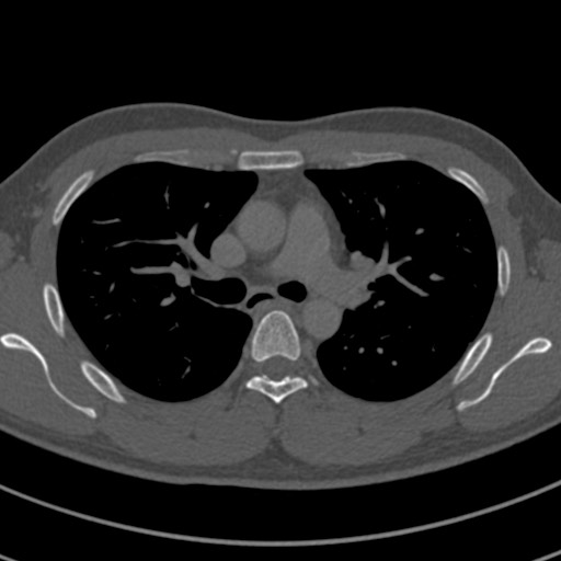 Apical lung mass mimic - neurogenic tumor (Radiopaedia 59918-67521 Axial bone window 33).jpg